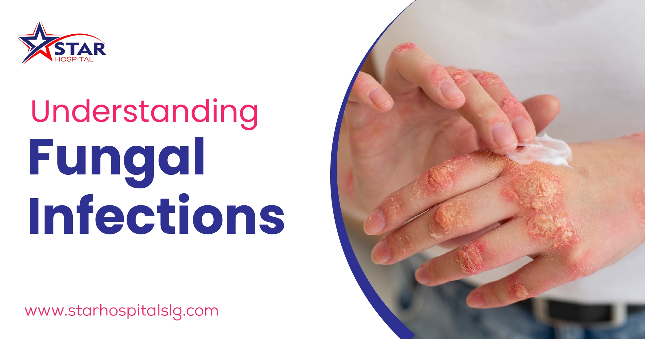 Fungal Infections: A Comprehensive guide by Dermatologist Dr. Anisha Najeeb, MD Star Hospital Siliguri